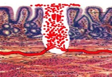 КРОВОТЕЧЕНИЕ И ДЕКОМПЕНСИРОВАННЫЙ ДУОДЕНОСТЕНОЗ: ТАКТИЧЕСКИЕ ОСОБЕННОСТИ ХИРУРГИЧЕСКОГО ЛЕЧЕНИЯ СОЧЕТАННЫХ ПАТОЛОГИЙ
