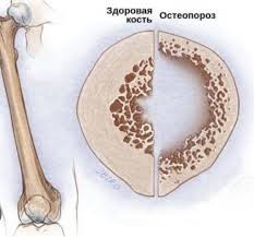 САЛОМАТИИ УСТУХОНҲО АЗ КӮДАКӢ ОҒОЗ МЕЁБАД: ПЕШГИРИИ ОСТЕОПОРОЗ