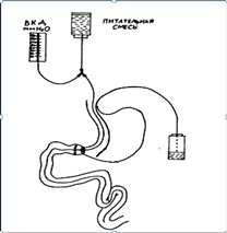 МУЛЬТИДИСЦИПЛИНАРНЫЙ ПОДХОД К РАННЕЙ ЭНТЕРАЛЬНОЙ ТЕРАПИИ ОСЛОЖНЕННОЙ ЯЗВЕННОЙ БОЛЕЗНИ 12 КИШКИ