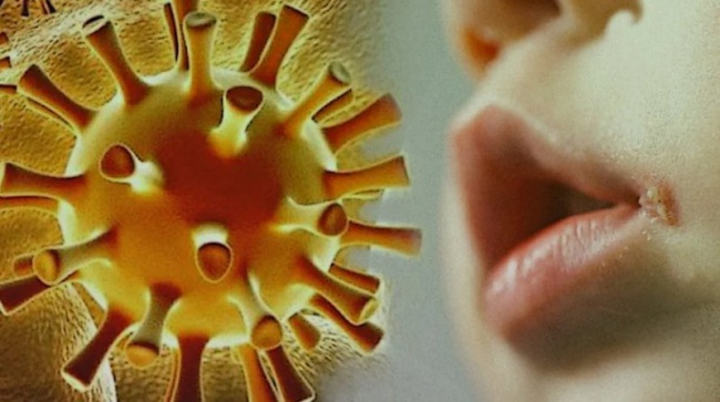 Что такое герпес и как избежать заражения им?