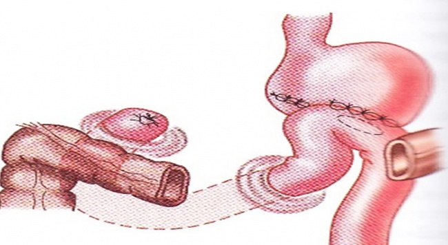 ПРОГНОСТИЧЕСКОЕ КРИТЕРИИ (ПРЕДИКТОРЫ) СЛОЖНОСТИ МОБИЛИЗАЦИИ ПИЛОРОДУОДЕНАЛЬНОЙ ЗОНЫ В ХИРУРГИЧЕСКОМ ЛЕЧЕНИИ «ТРУДНЫХ» И «НЕУДАЛИМЫХ» СТЕНОЗИРУЮЩИХ ЯЗВ 12 КИШКИ ПРОГНОСТИЧЕСКОЕ КРИТЕРИИ (ПРЕДИКТОРЫ) СЛОЖНОСТИ МОБИЛИЗАЦИИ ПИЛОРОДУОДЕНАЛЬНОЙ ЗОНЫ В ХИРУРГИЧЕСКОМ ЛЕЧЕНИИ «ТРУДНЫХ» И «НЕУДАЛИМЫХ» СТЕНОЗИРУЮЩИХ ЯЗВ 12 КИШКИ