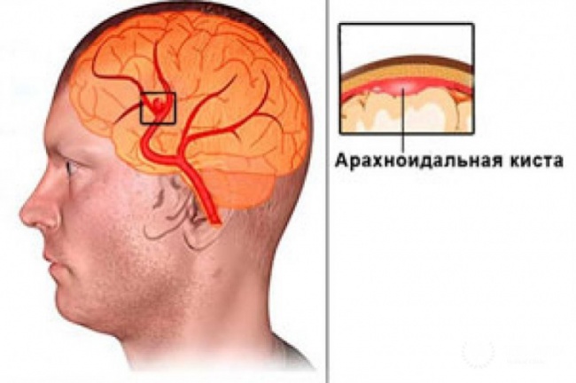 Арахноидальная киста головного мозга