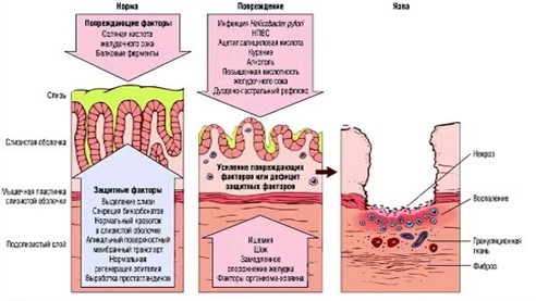 ФЕНОМЕН «СИНДРОМА ВЗАИМНОГО ОТЯГОЩЕНИЯ» ПРИ СОЧЕТАННЫХ ОСЛОЖНЕНИЯХ ЯЗВЕННОЙ БОЛЕЗНИ ДВЕНАДЦАТИПЕРСТНОЙ КИШКИ